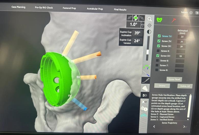 Screen showing robotic planning of cup and screw placement in hip replacement