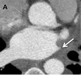 Chest CT
