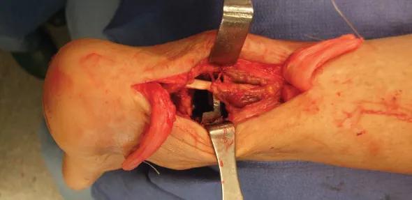 Figure 2. Posterior approach to ankle fusion using a Z cut. The Achilles tendon ends are sutured down to clear the surgical area and reduce tension on the skin from prolonged retraction. 