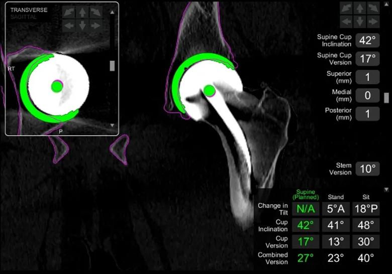 Robotic template planning hip reconstruction