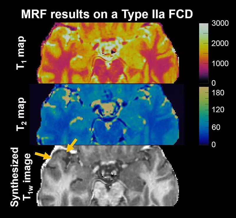 Brain scan of patients with epilepsy