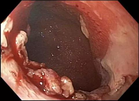 stricture need