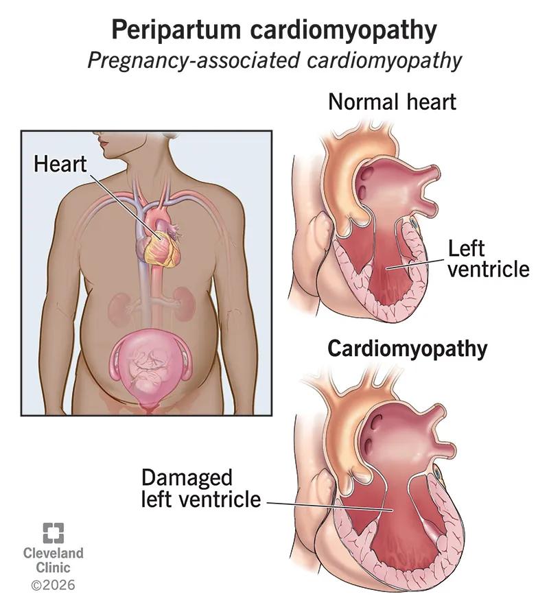 Normal heart compared to one with peripartum cardiomyopathy