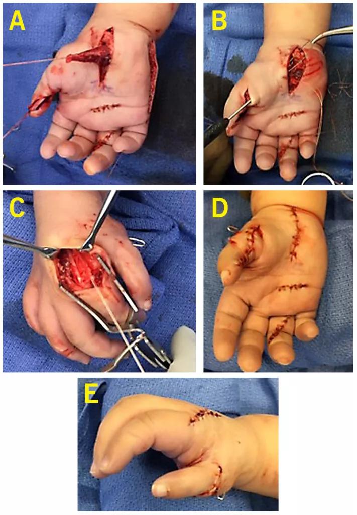 ADM muscle mobilized from the ulnar side of hand.