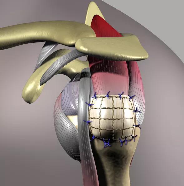 Schematic illustration of the reinforced allograft fascia lata patch.