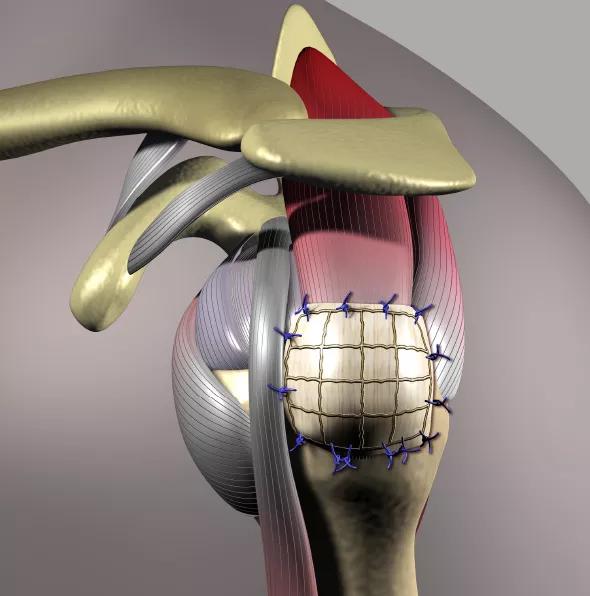 Progress in Rotator Cuff Repair Extends to the Lab