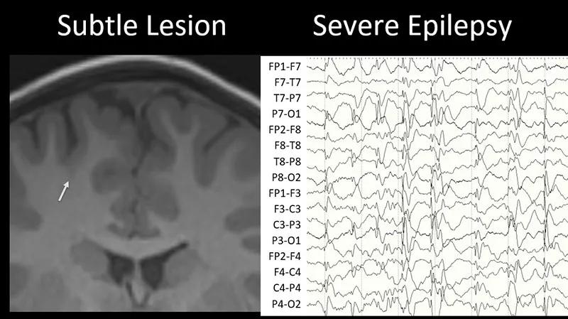 brain MRIs