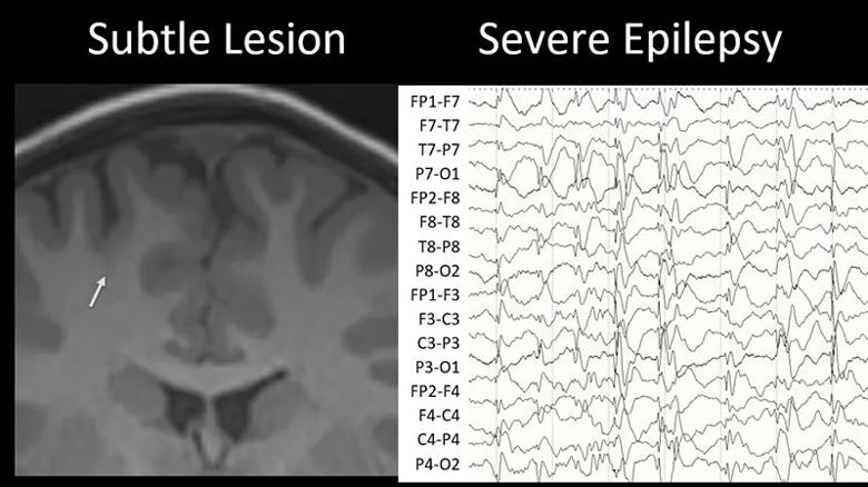 brain MRIs