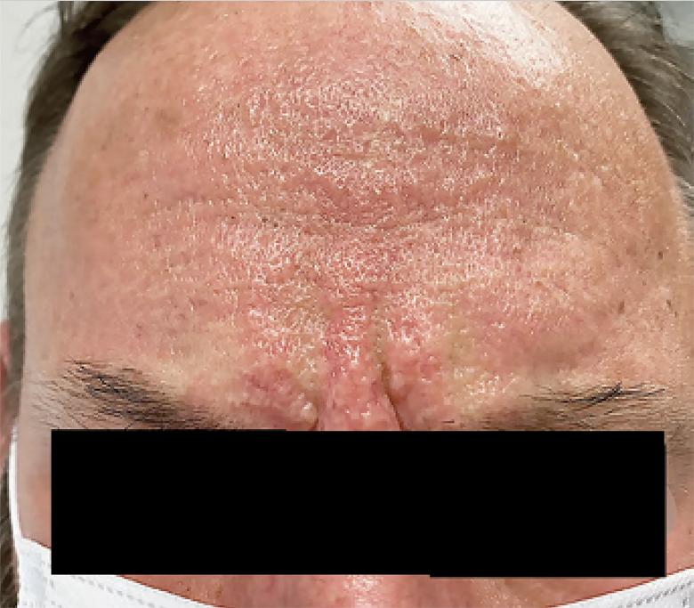 Greasy papules on the patient's forehead  led to the formation of glabellar grooves 