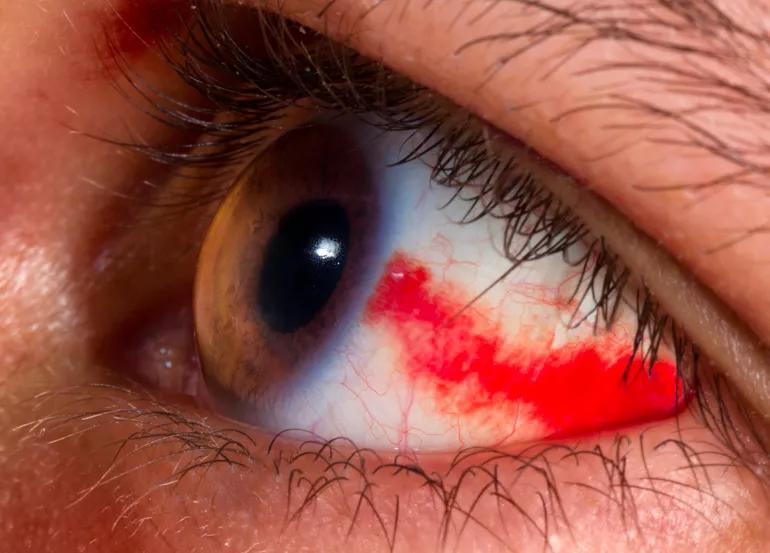 Red splotch in white of an eye