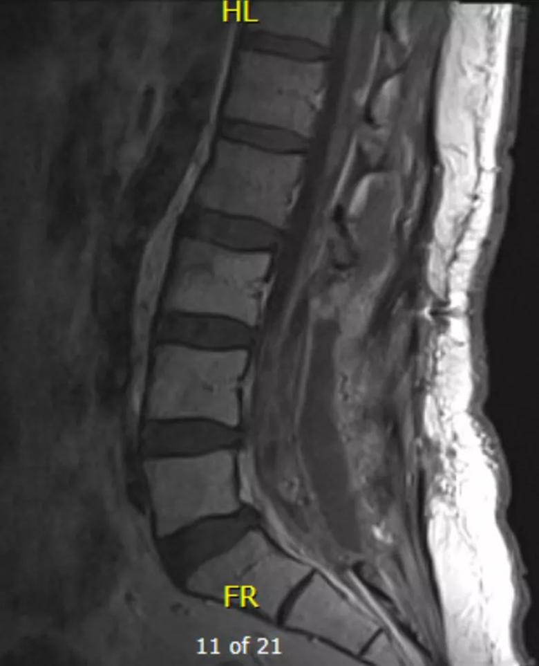 MRI showing scar tissue after partial resection of a spinal ependymoma