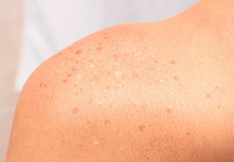 White Spots on Skin From Sun: What Are They?