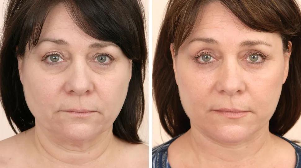 Facelift before & after photo