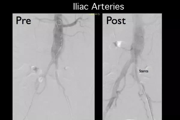 Figure 6. The iliac arteries before (left) and after (right) the procedure.