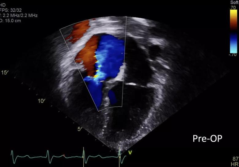 echocardiogram showing severe tricuspid regurgitation