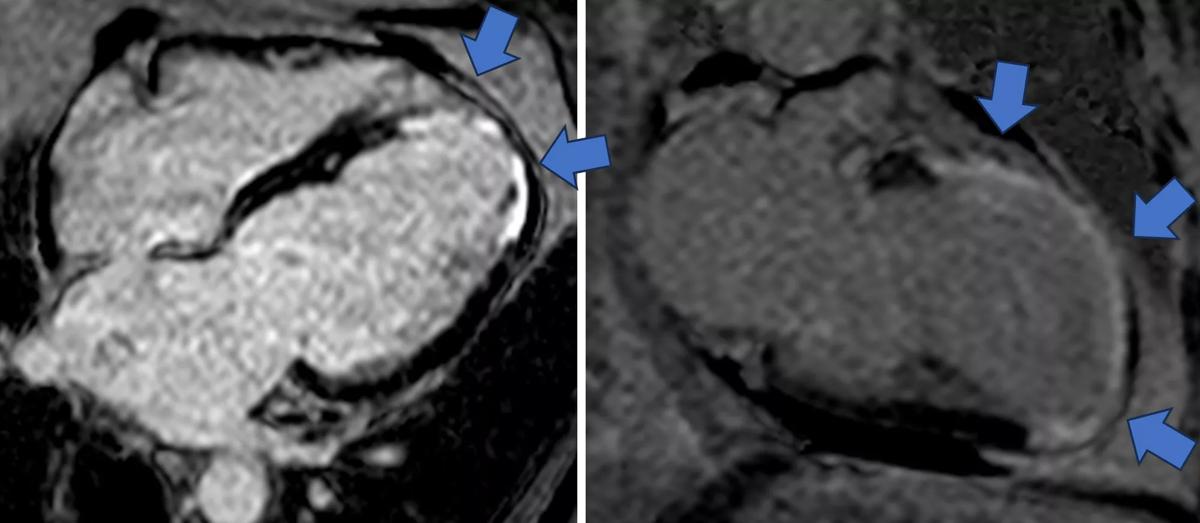 cine cardiac MRI image for phenogroup 3