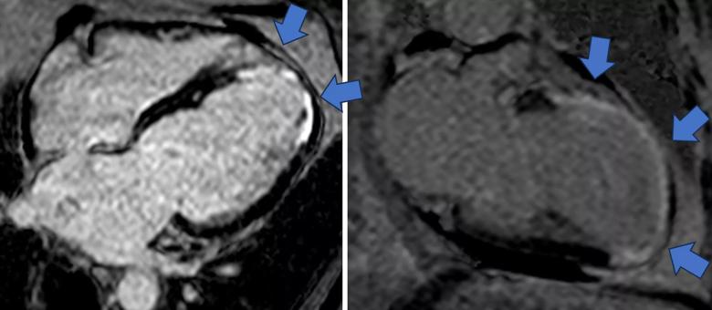 cine cardiac MRI image for phenogroup 3