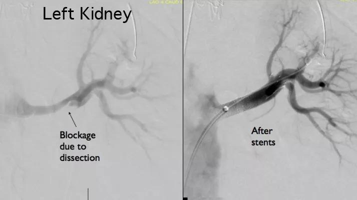 Figure 5. Renal arteriographs showing blockage before surgery (left) and the result of the surgical repair (right).