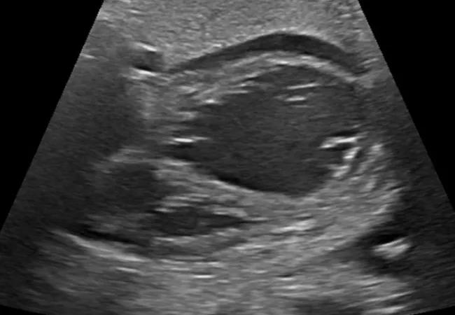 Fetal echocardiogram showing severe left ventricular dilation