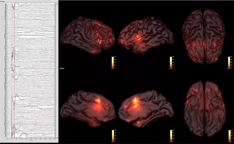 CCEP responses are depicted as waveforms with response estimates depicted by scaled colors in the MRI scans
