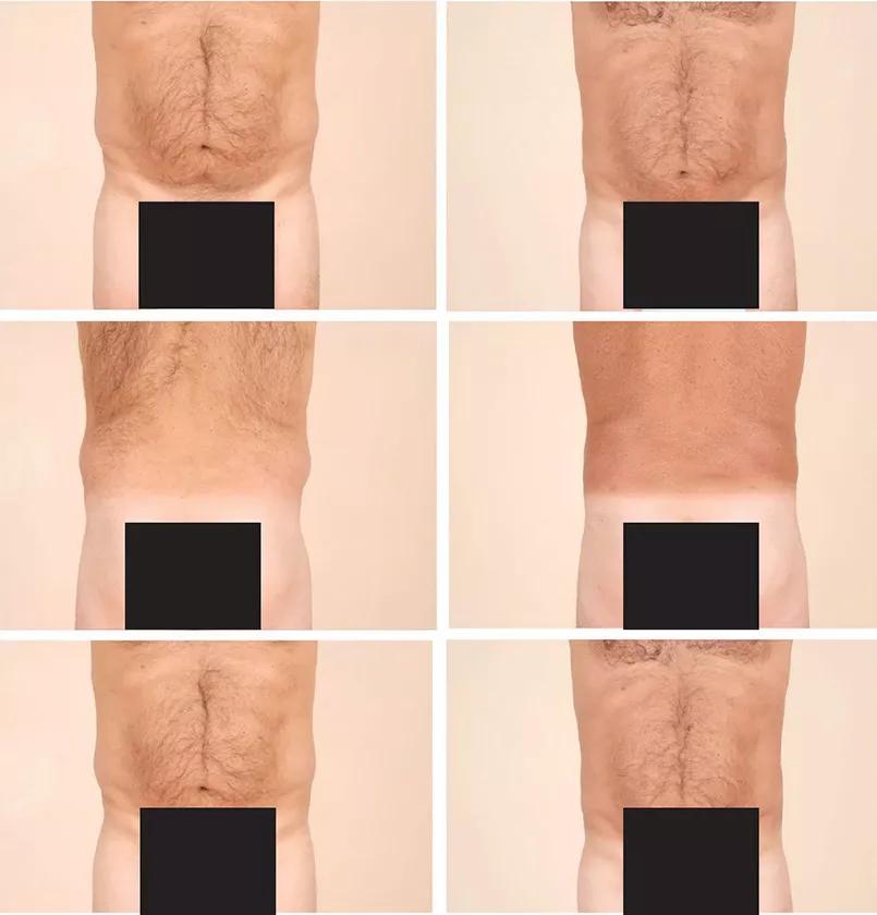 Liposuction