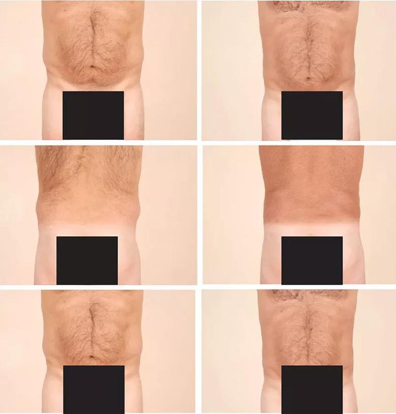 Liposuction