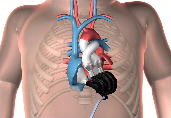 Artificial heart
