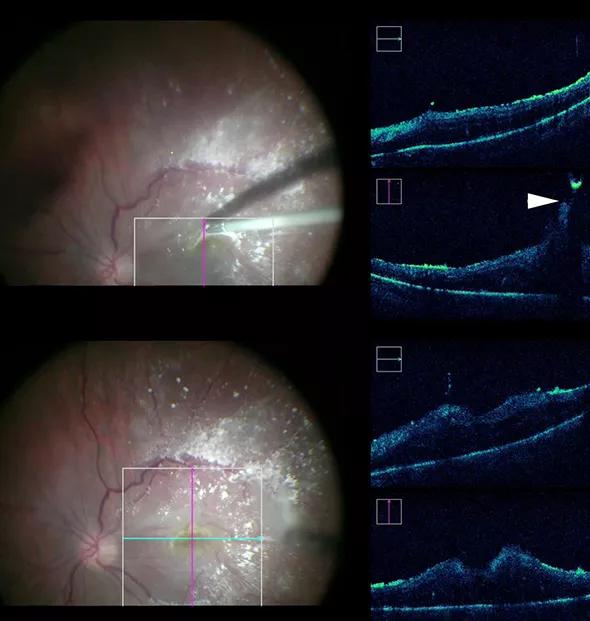 Microscope-Integrated Intraoperative OCT Advances State-of-the-Art ...