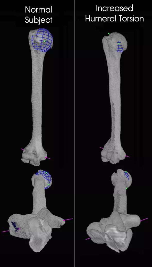 Figure. Volume-rendered CTs of humeri in two pitchers. The images on the right show increased humeral torsion, as indicated by the epicondylar axis lines (pink).