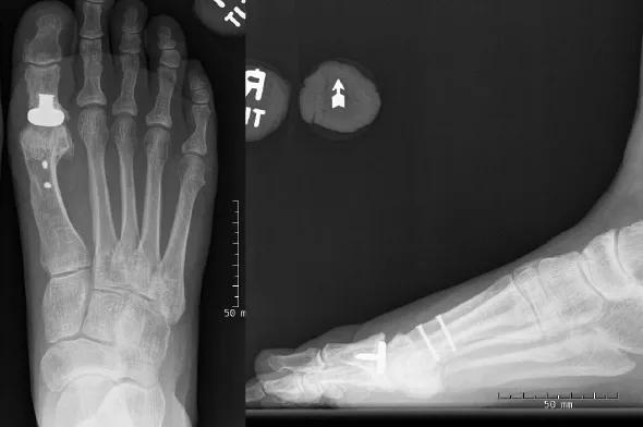 Figures  Preoperative anteroposterior and lateral weight-bearing X-ray views of a 54-year-old woman with a five-year history of right first MTP joint pain. Hemiarthroplasty and metatarsal osteotomy were performed 10 years earlier. 
