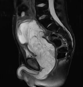 Preoperative MRI Pelvis