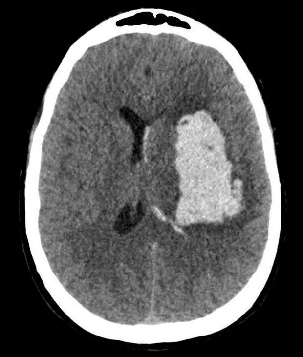 axial head CT showing basal ganglia hemorrhage