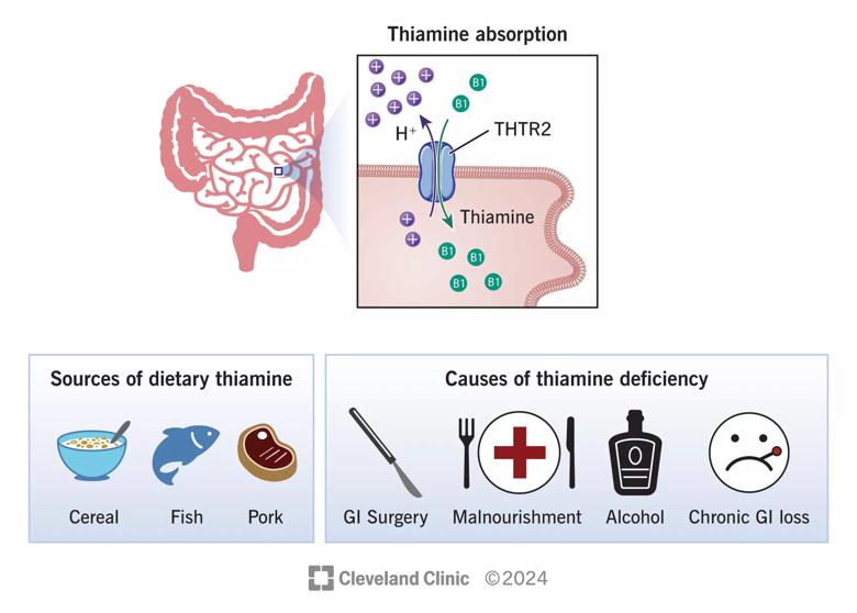 Thiamine deficiency