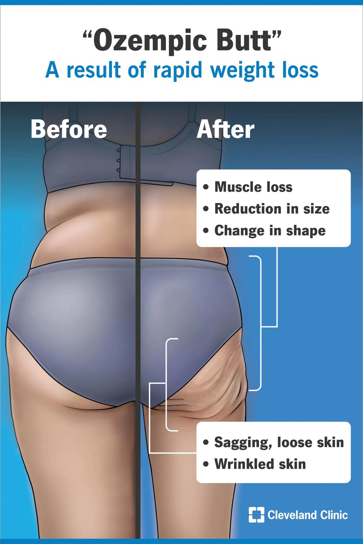 "Ozempic butt," with wrinkly, sagging skin