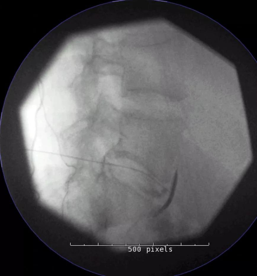 A neurolytic hypogastric plexus block for advanced colon cancer.