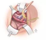 F. Graft positioning in retroperitoneal pocket with vascular anastomosis completed