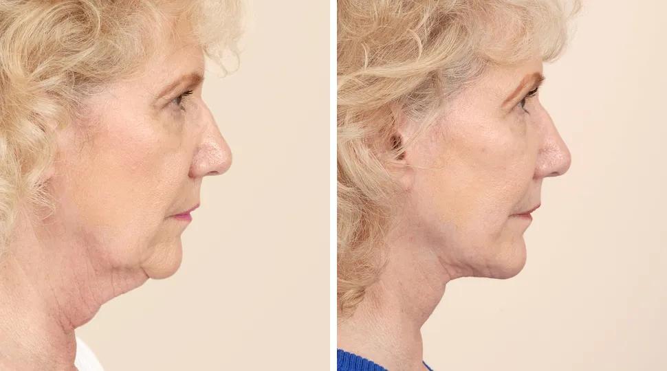 Facelift before & after photo