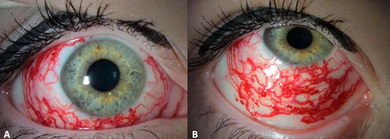 16-eye-2702-hc-surgery-cqd-inset-1