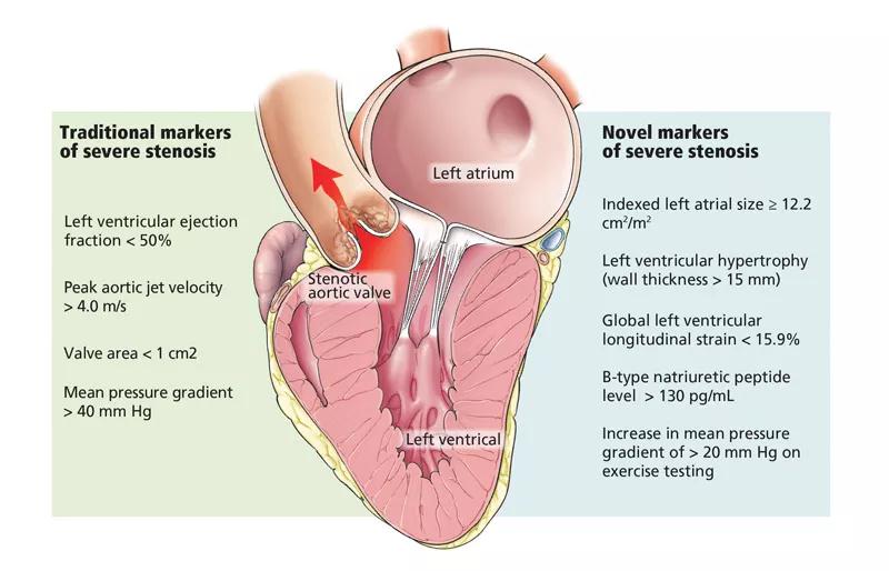 Aortic Stenosis