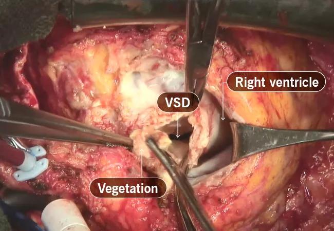 intraoperative photo from a congenital heart surgery