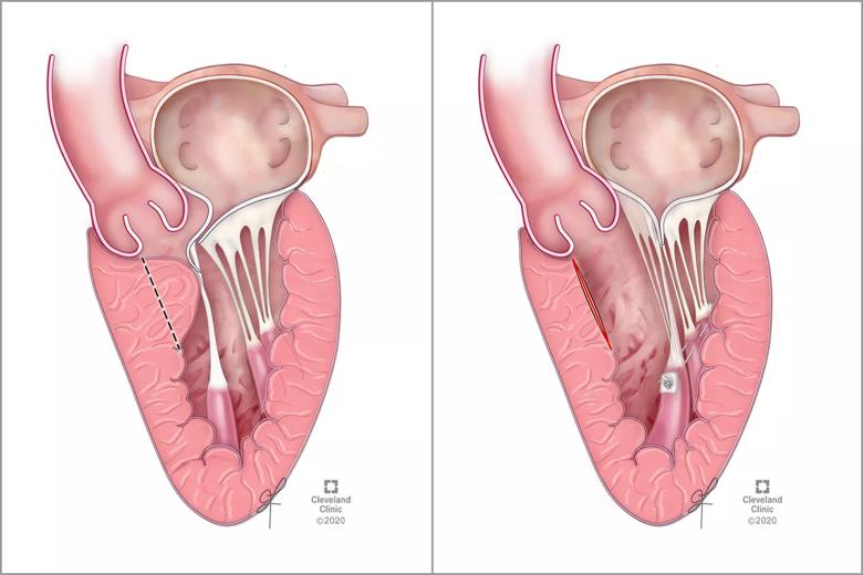 robotic myectomy and mitral valve repair