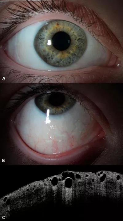 16-eye-2702-hc-surgery-cqd-inset-2