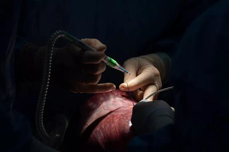 Using the cautery, Dr. Cass prepares to open the uterine cavity.