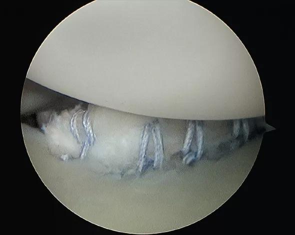 Figure 3. Arthroscopic photo of the suture anchors tying down the labrum to the glenoid rim (photo bottom) to restore stability to the glenohumeral joint. (The humeral head is the white dome at the top of the image.) 