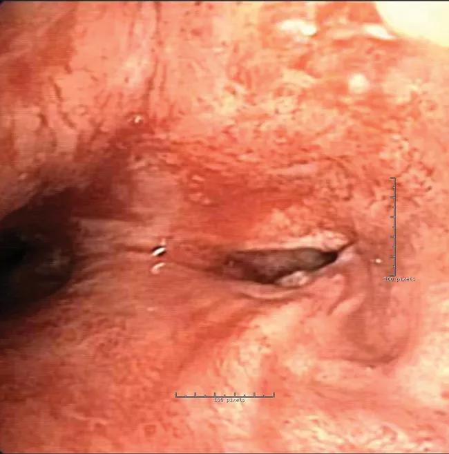 Main carina, below the stenosis.