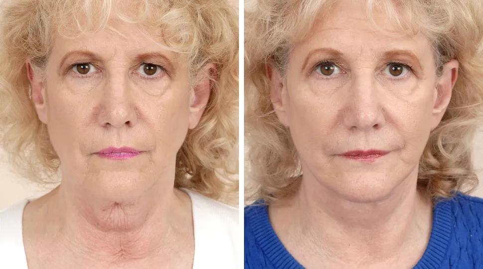 Facelift before & after photo