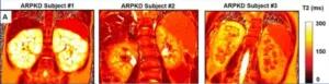 Kidney disease