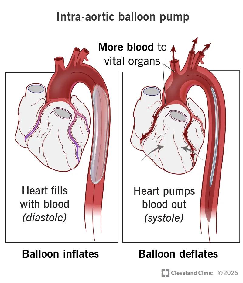 An intra-aortic balloon pump helping a heart pump more blood