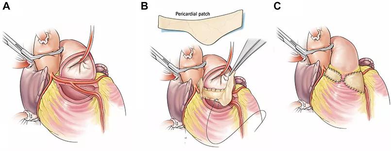 Illustration of key steps in the Najm procedure.