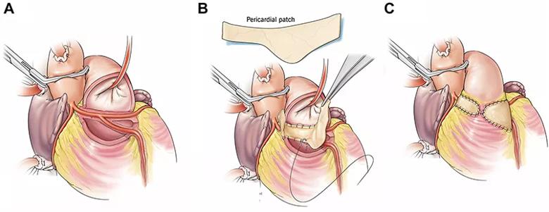 Illustration of key steps in the Najm procedure.
